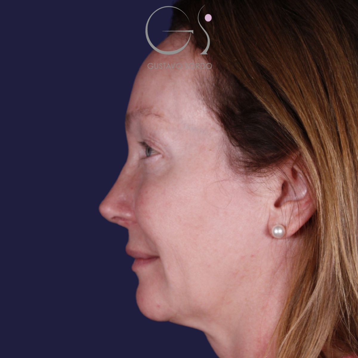 Rinoplastia: antes y después de un caso operado por el Dr. Gustavo Sordo en Madrid