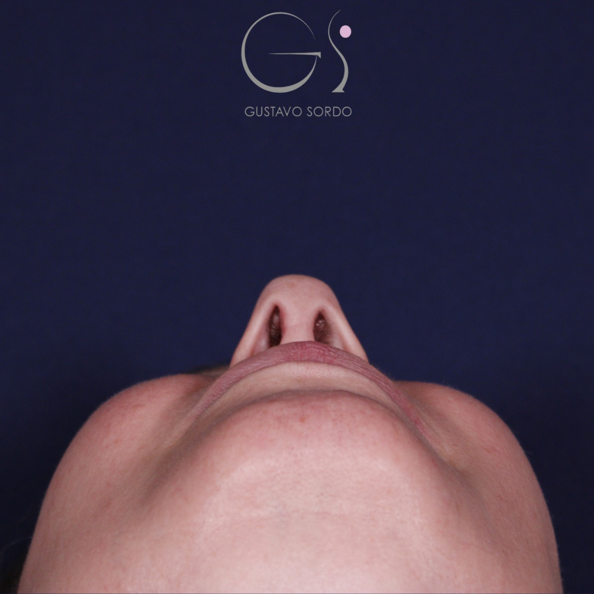 Rinoplastia: antes y después de un caso operado por el Dr. Gustavo Sordo en Madrid