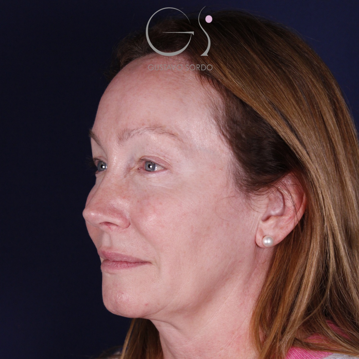 Rinoplastia: antes y después de un caso operado por el Dr. Gustavo Sordo en Madrid