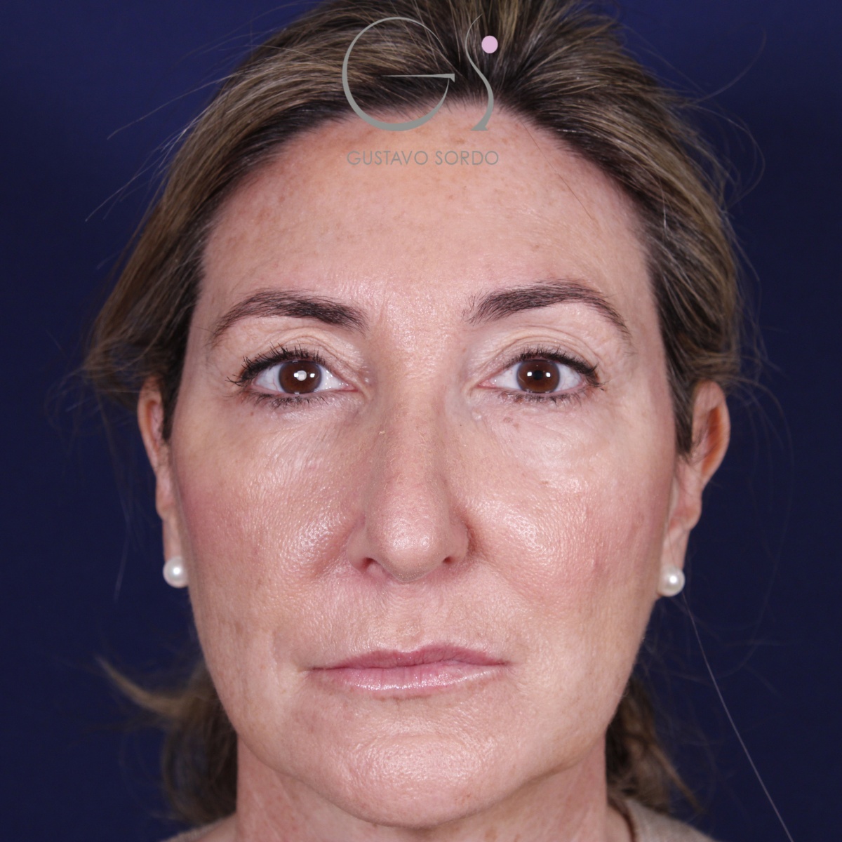 Rinoplastia ultrasónica en mujer con nariz aguileña, punta caída y piel gruesa, antes de la operación (1)