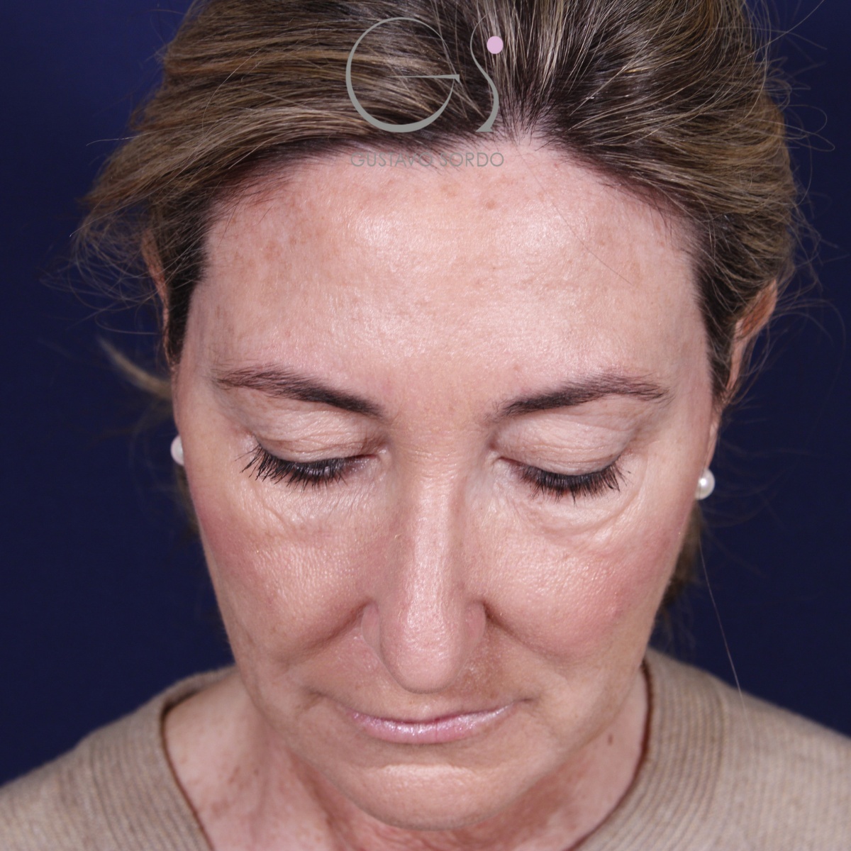 Rinoplastia ultrasónica en mujer con nariz aguileña, punta caída y piel gruesa, antes de la operación (2)