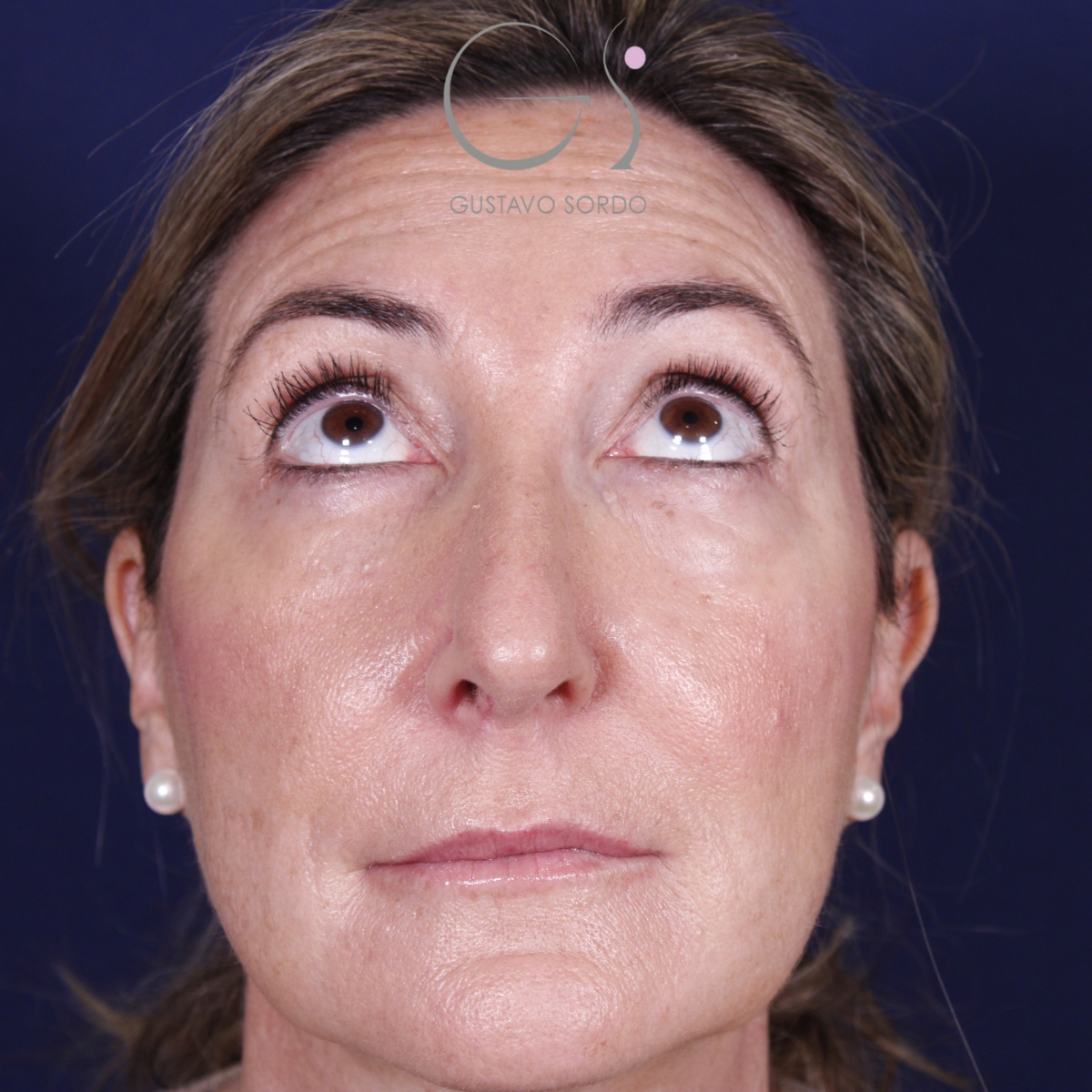 Rinoplastia ultrasónica en mujer con nariz aguileña, punta caída y piel gruesa, antes de la operación (3)