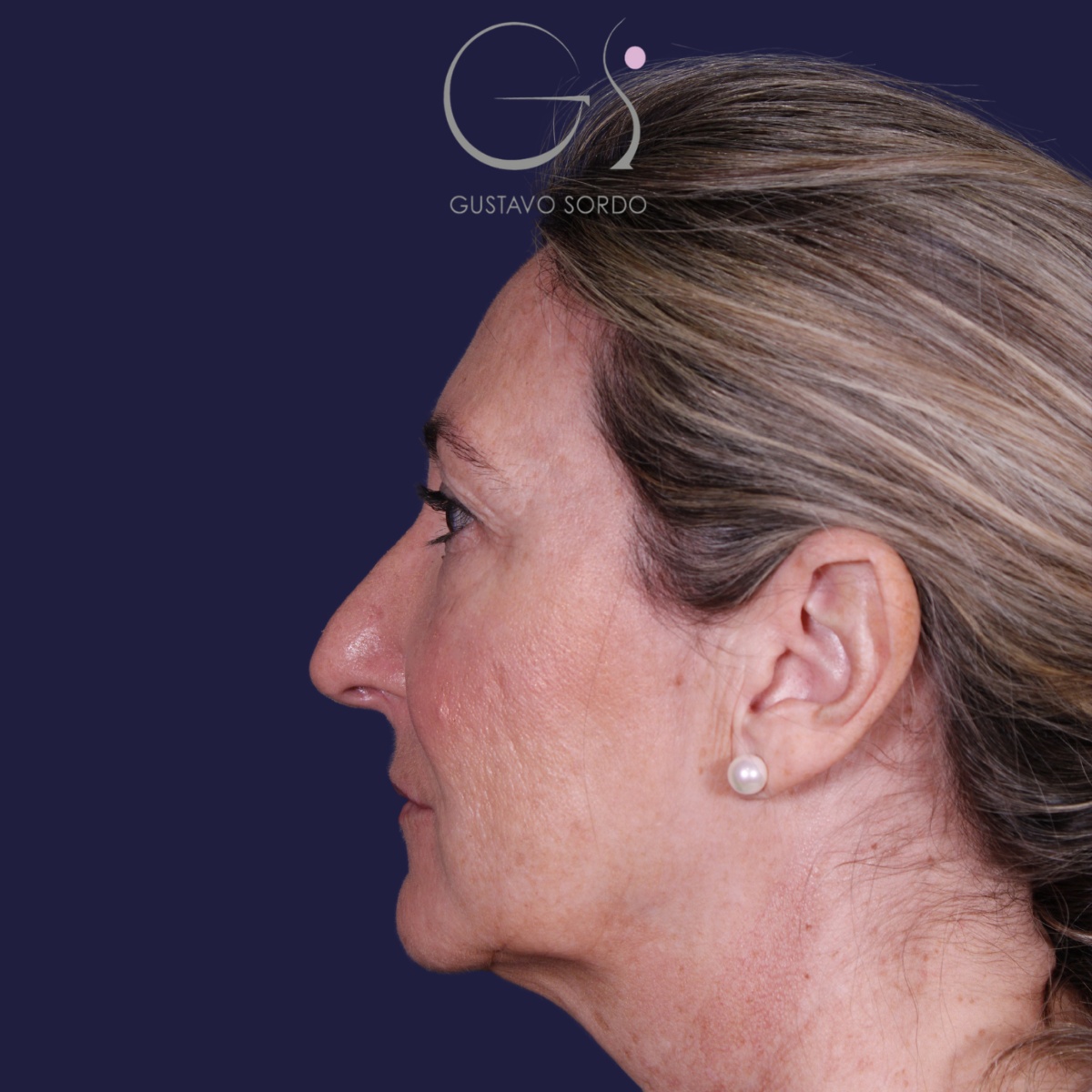 Rinoplastia ultrasónica en mujer con nariz aguileña, punta caída y piel gruesa, antes de la operación (4)