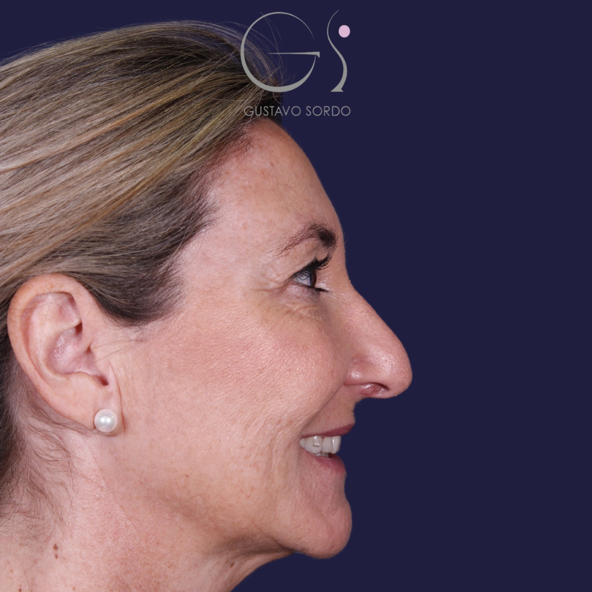 Rinoplastia ultrasónica en mujer con nariz aguileña, punta caída y piel gruesa, antes de la operación (6)