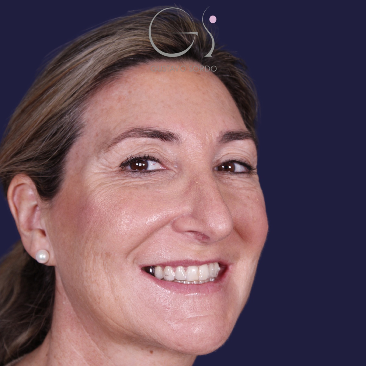 Rinoplastia ultrasónica en mujer con nariz aguileña, punta caída y piel gruesa, antes de la operación (7)