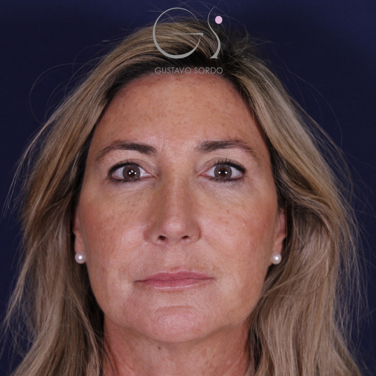 Rinoplastia ultrasónica en mujer con nariz aguileña, punta caída y piel gruesa, después de la operación (1)