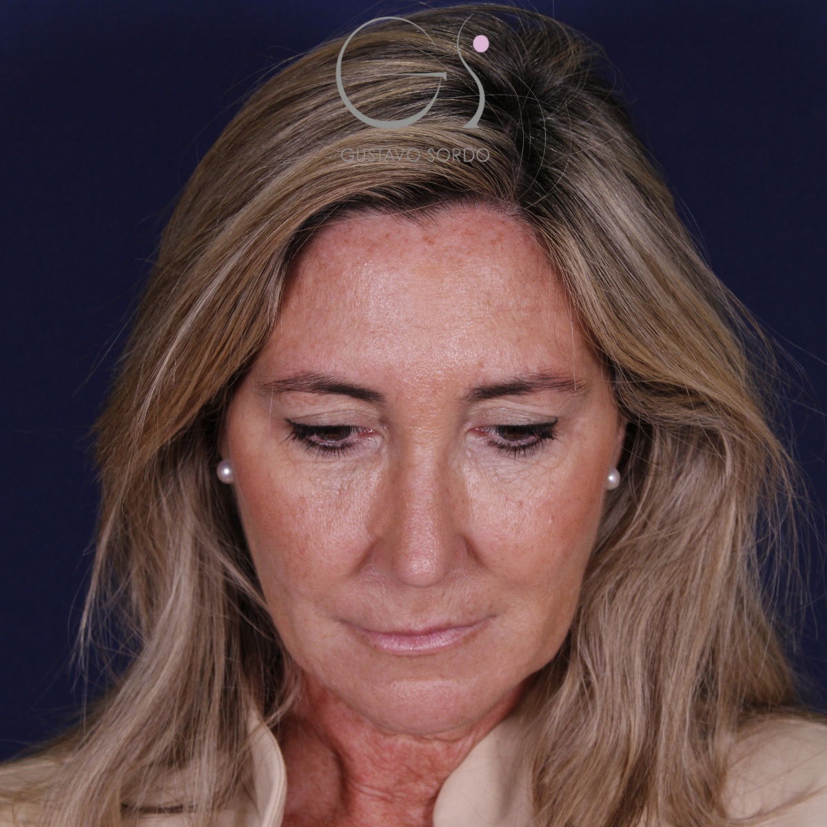 Rinoplastia ultrasónica en mujer con nariz aguileña, punta caída y piel gruesa, después de la operación (2)