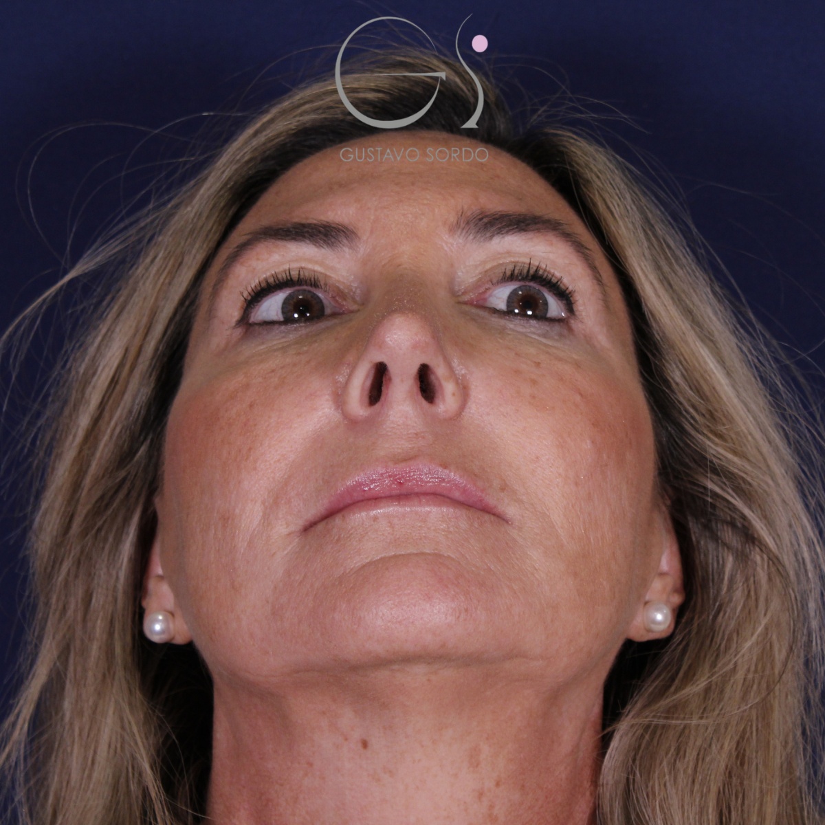 Rinoplastia ultrasónica en mujer con nariz aguileña, punta caída y piel gruesa, después de la operación (3)