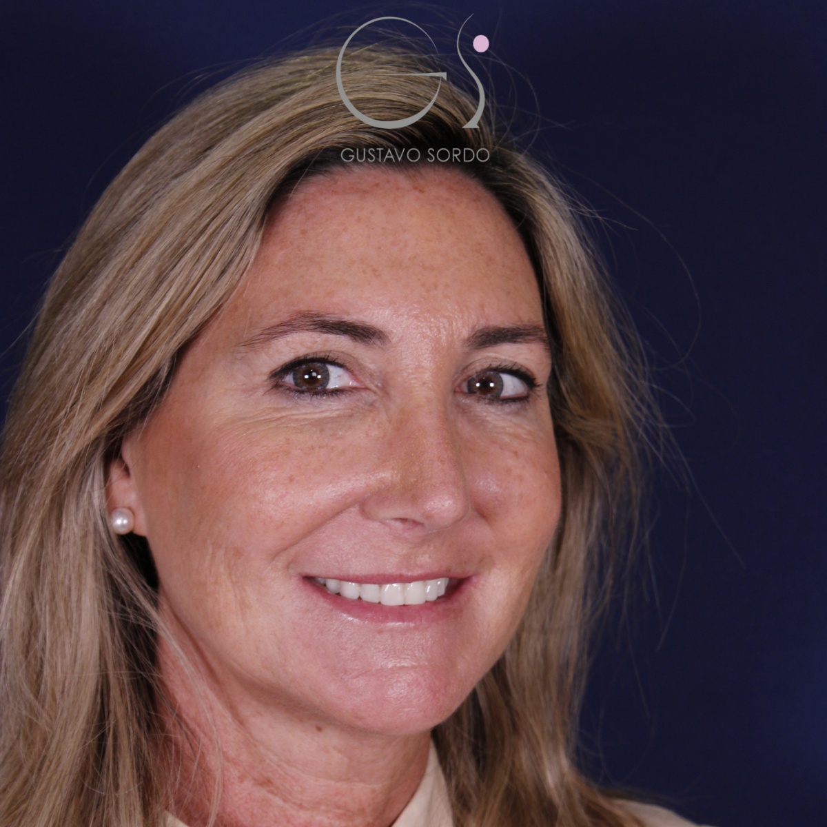 Rinoplastia ultrasónica en mujer con nariz aguileña, punta caída y piel gruesa, después de la operación (7)