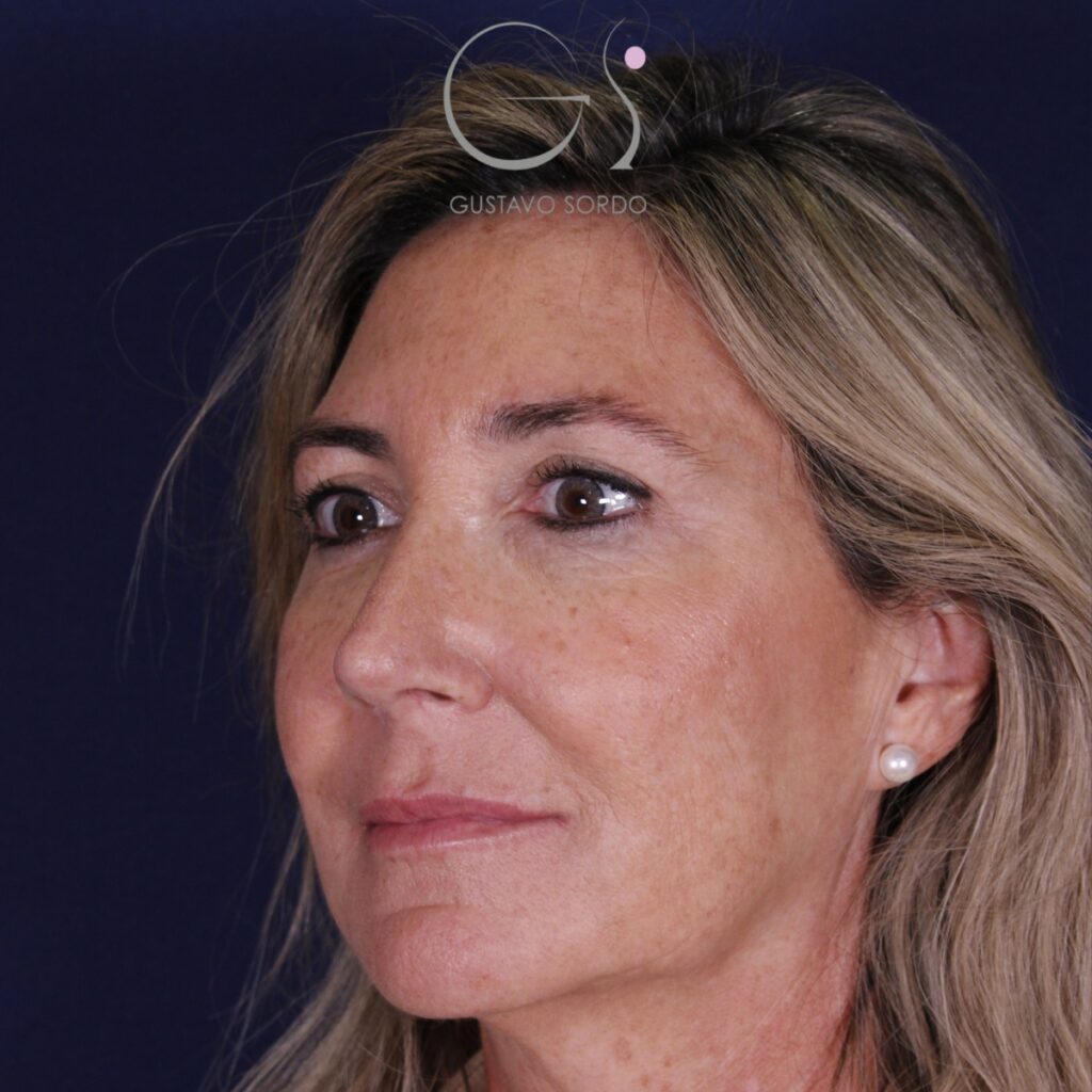 Rinoplastia ultrasónica en mujer con nariz aguileña, punta caída y piel gruesa, después de la operación (5)