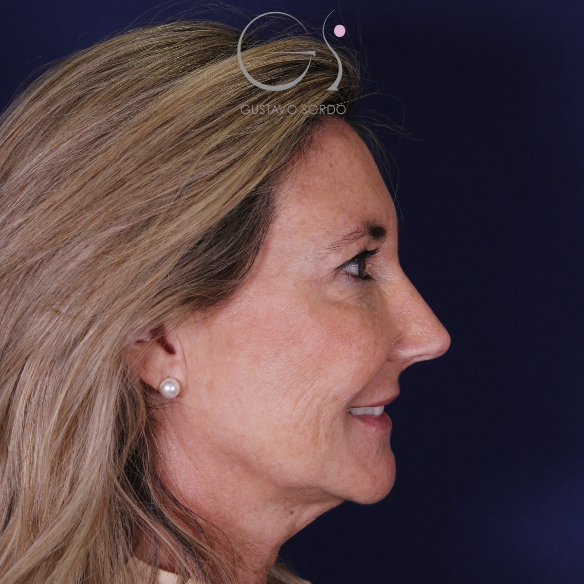 Rinoplastia ultrasónica en mujer con nariz aguileña, punta caída y piel gruesa, después de la operación (6)