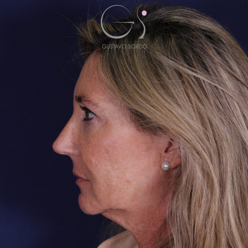 Rinoplastia ultrasónica en mujer con nariz aguileña, punta caída y piel gruesa, después de la operación (4)