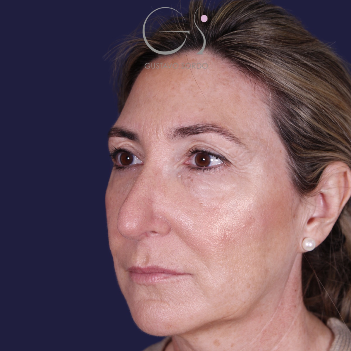 Rinoplastia ultrasónica en mujer con nariz aguileña, punta caída y piel gruesa, antes de la operación (5)