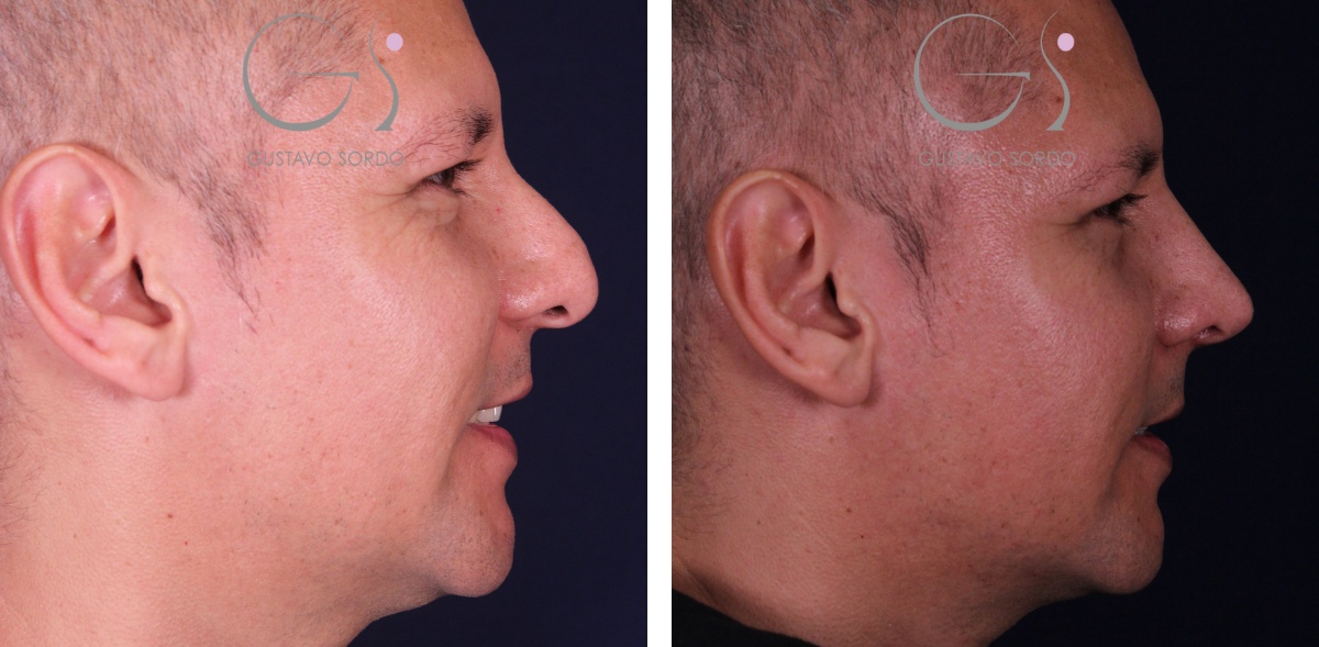 Resultado natural de rinoplastia de preservación