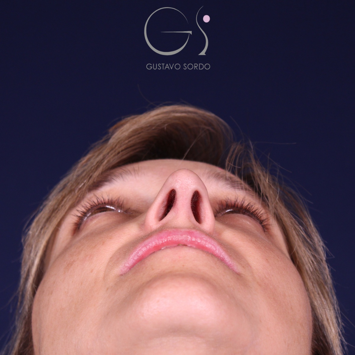 Rinoplastia — nariz aguileña: antes y después de un caso operado por el Dr. Gustavo Sordo en Madrid
