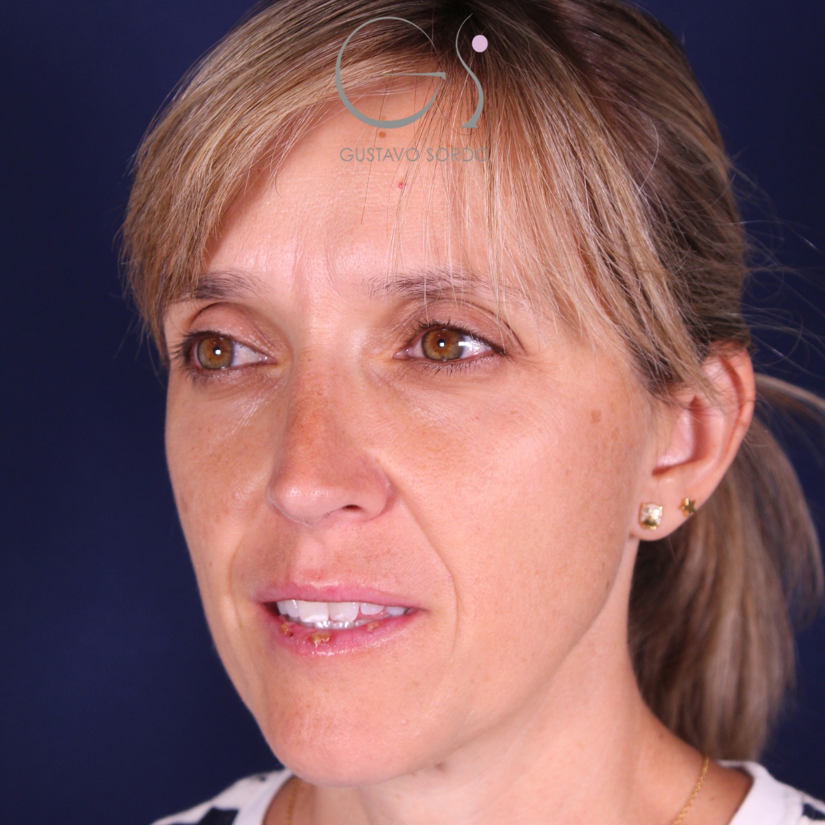 Rinoplastia — nariz aguileña: antes y después de un caso operado por el Dr. Gustavo Sordo en Madrid