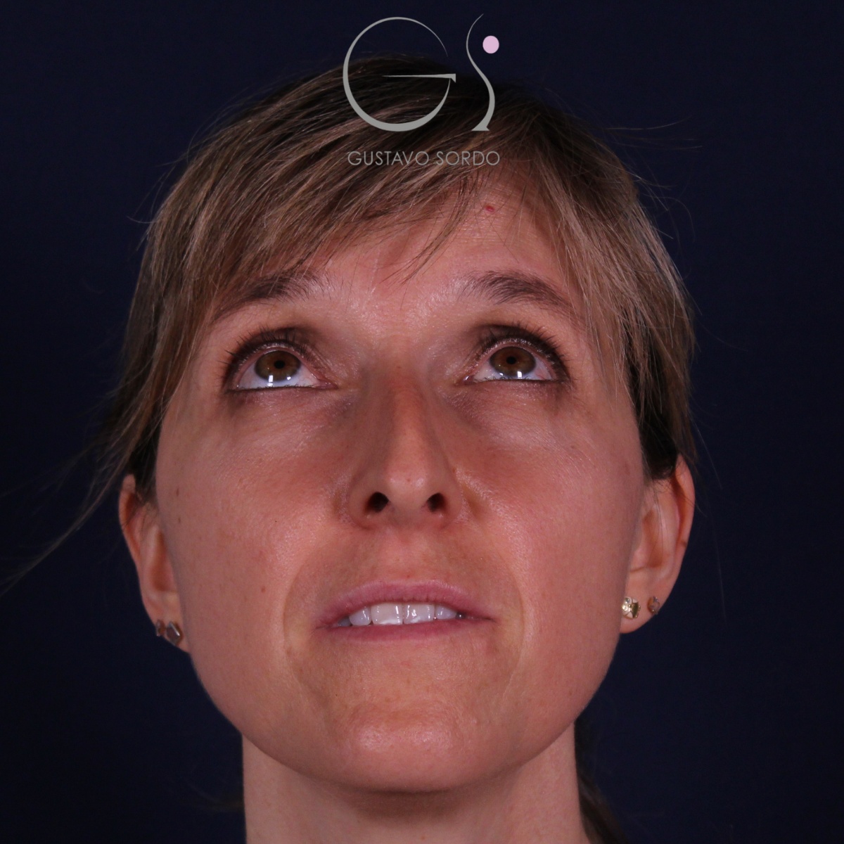 Rinoplastia — nariz aguileña: antes y después de un caso operado por el Dr. Gustavo Sordo en Madrid