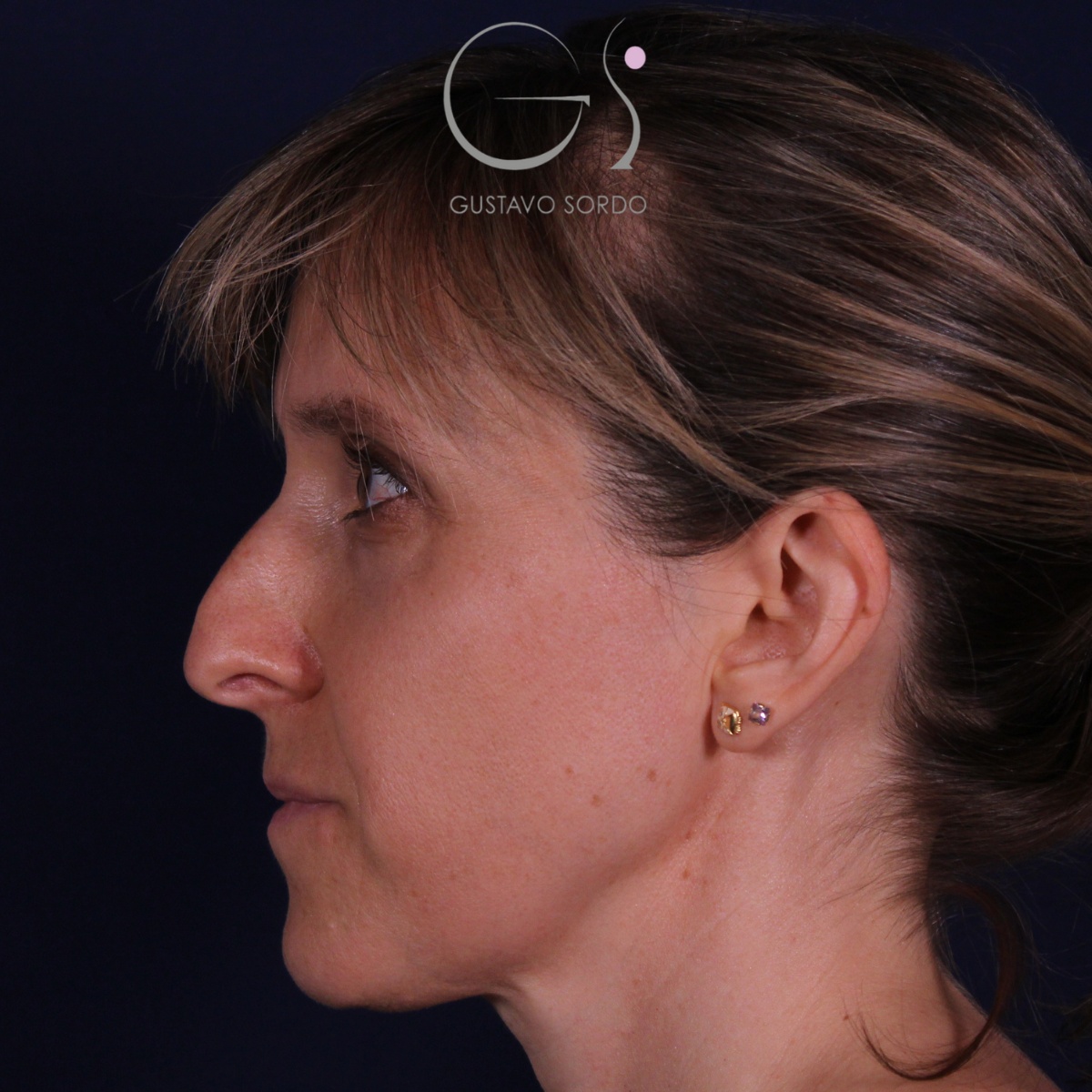 Rinoplastia — nariz aguileña: antes y después de un caso operado por el Dr. Gustavo Sordo en Madrid