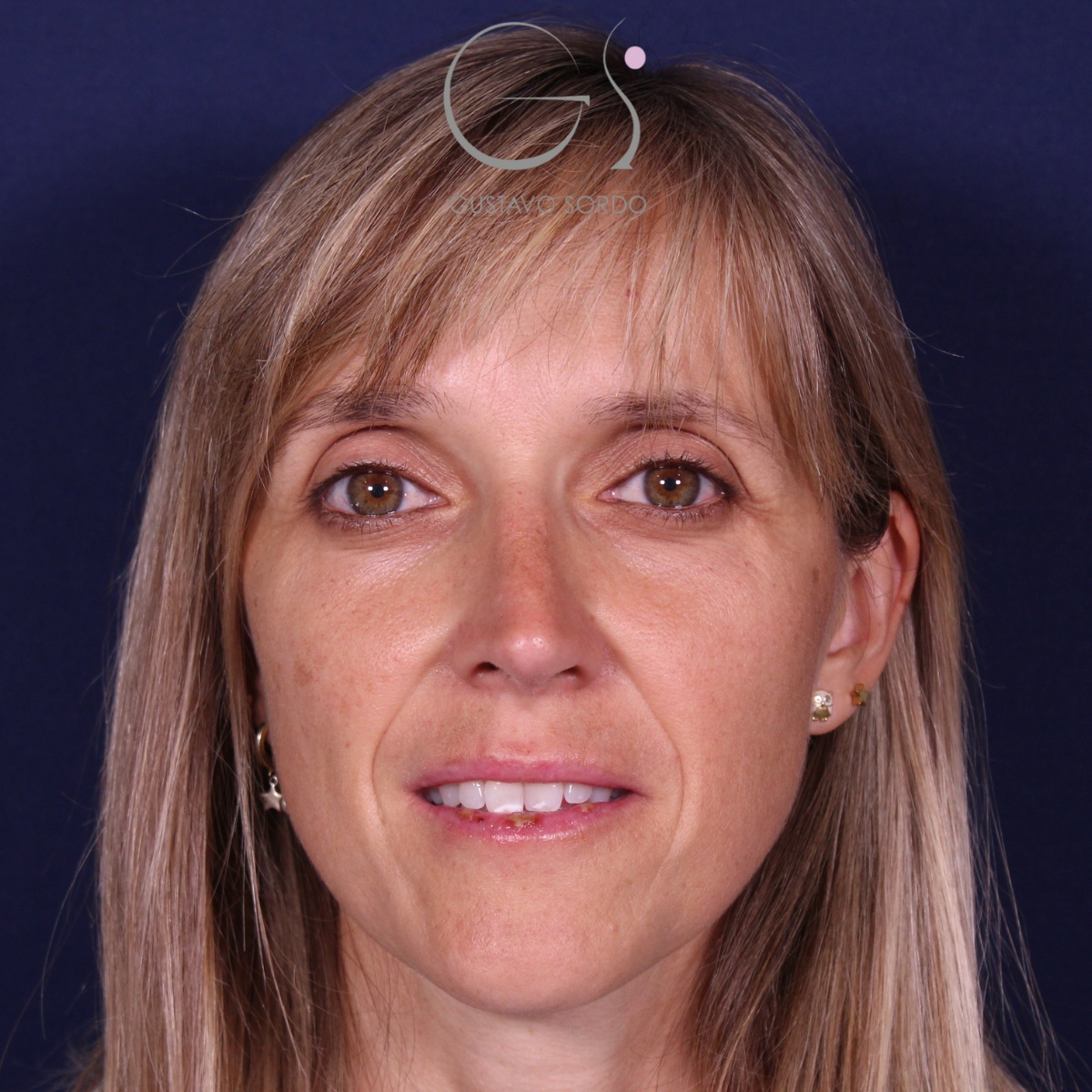 Rinoplastia — nariz aguileña: antes y después de un caso operado por el Dr. Gustavo Sordo en Madrid