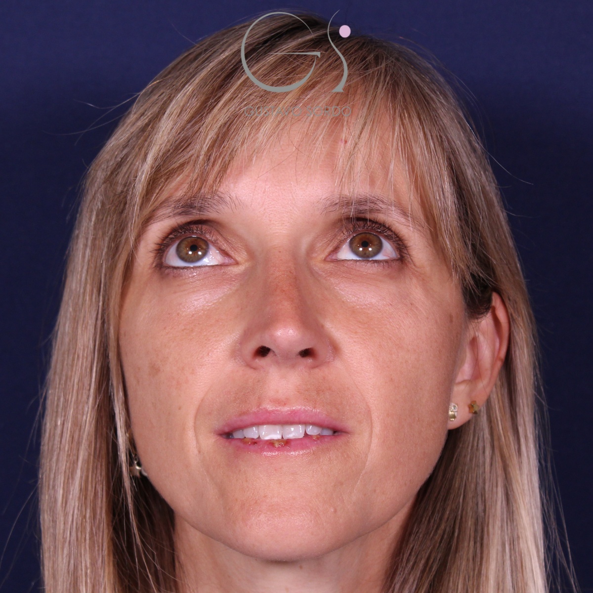 Rinoplastia — nariz aguileña: antes y después de un caso operado por el Dr. Gustavo Sordo en Madrid