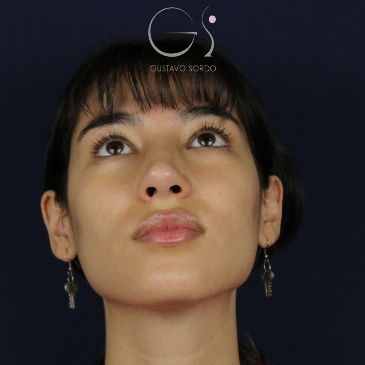 Rinoplastia — nariz aguileña: antes y después de un caso operado por el Dr. Gustavo Sordo en Madrid