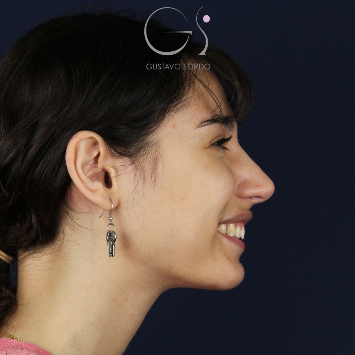Rinoplastia — nariz aguileña: antes y después de un caso operado por el Dr. Gustavo Sordo en Madrid
