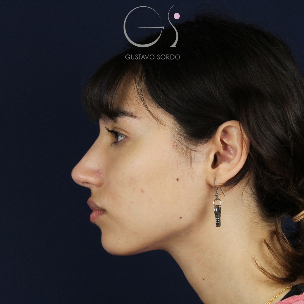 Rinoplastia — nariz aguileña: antes y después de un caso operado por el Dr. Gustavo Sordo en Madrid