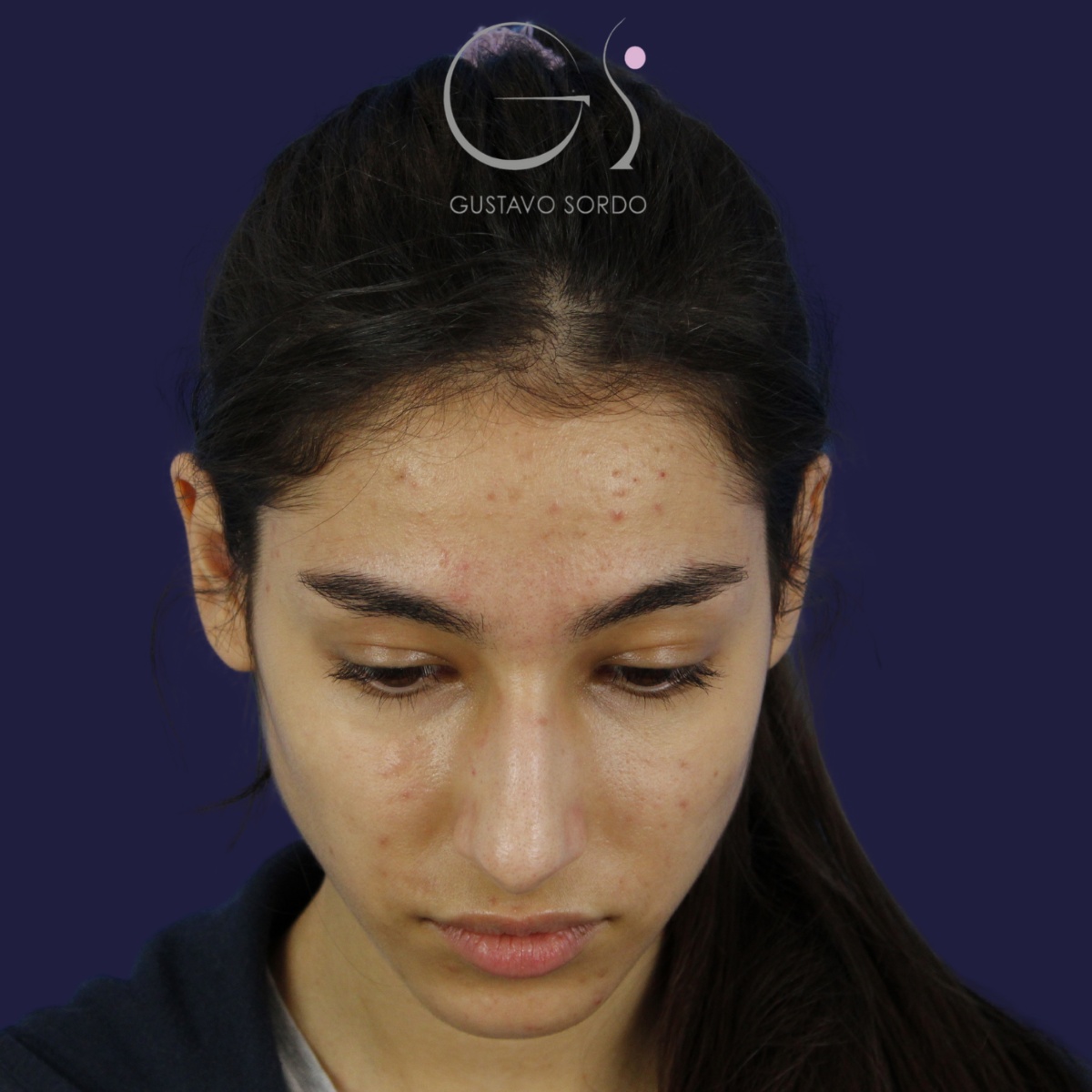 Rinoplastia — nariz aguileña: antes y después de un caso operado por el Dr. Gustavo Sordo en Madrid