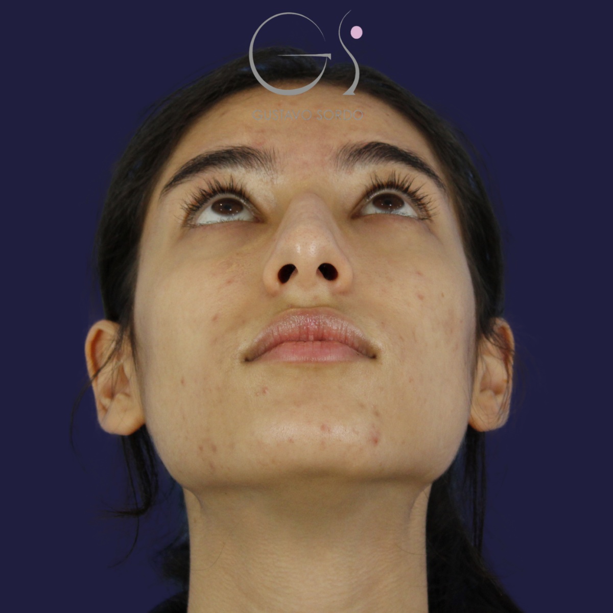 Rinoplastia — nariz aguileña: antes y después de un caso operado por el Dr. Gustavo Sordo en Madrid