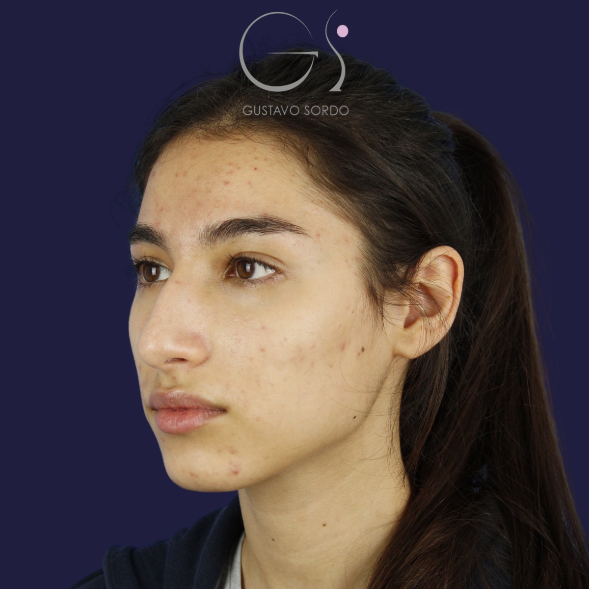 Rinoplastia — nariz aguileña: antes y después de un caso operado por el Dr. Gustavo Sordo en Madrid