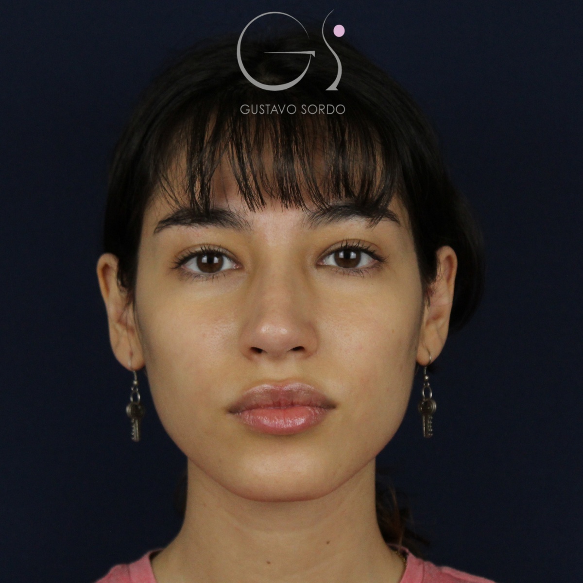 Rinoplastia — nariz aguileña: antes y después de un caso operado por el Dr. Gustavo Sordo en Madrid