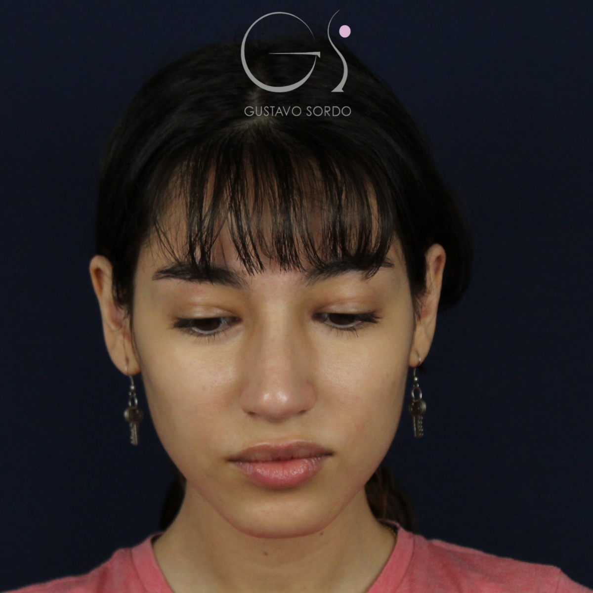 Rinoplastia — nariz aguileña: antes y después de un caso operado por el Dr. Gustavo Sordo en Madrid