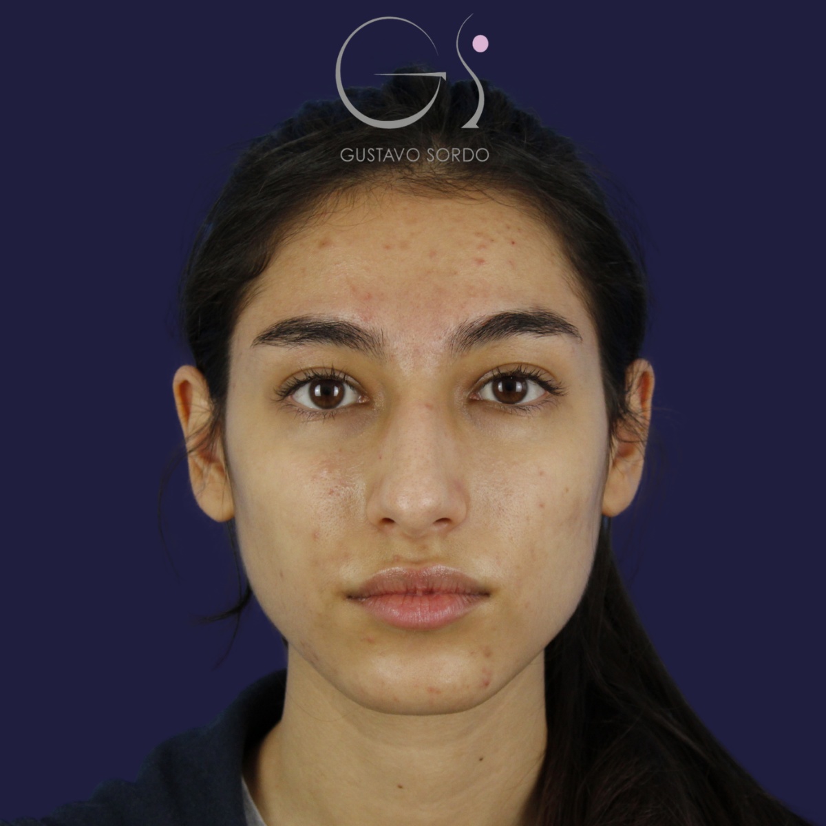 Rinoplastia — nariz aguileña: antes y después de un caso operado por el Dr. Gustavo Sordo en Madrid