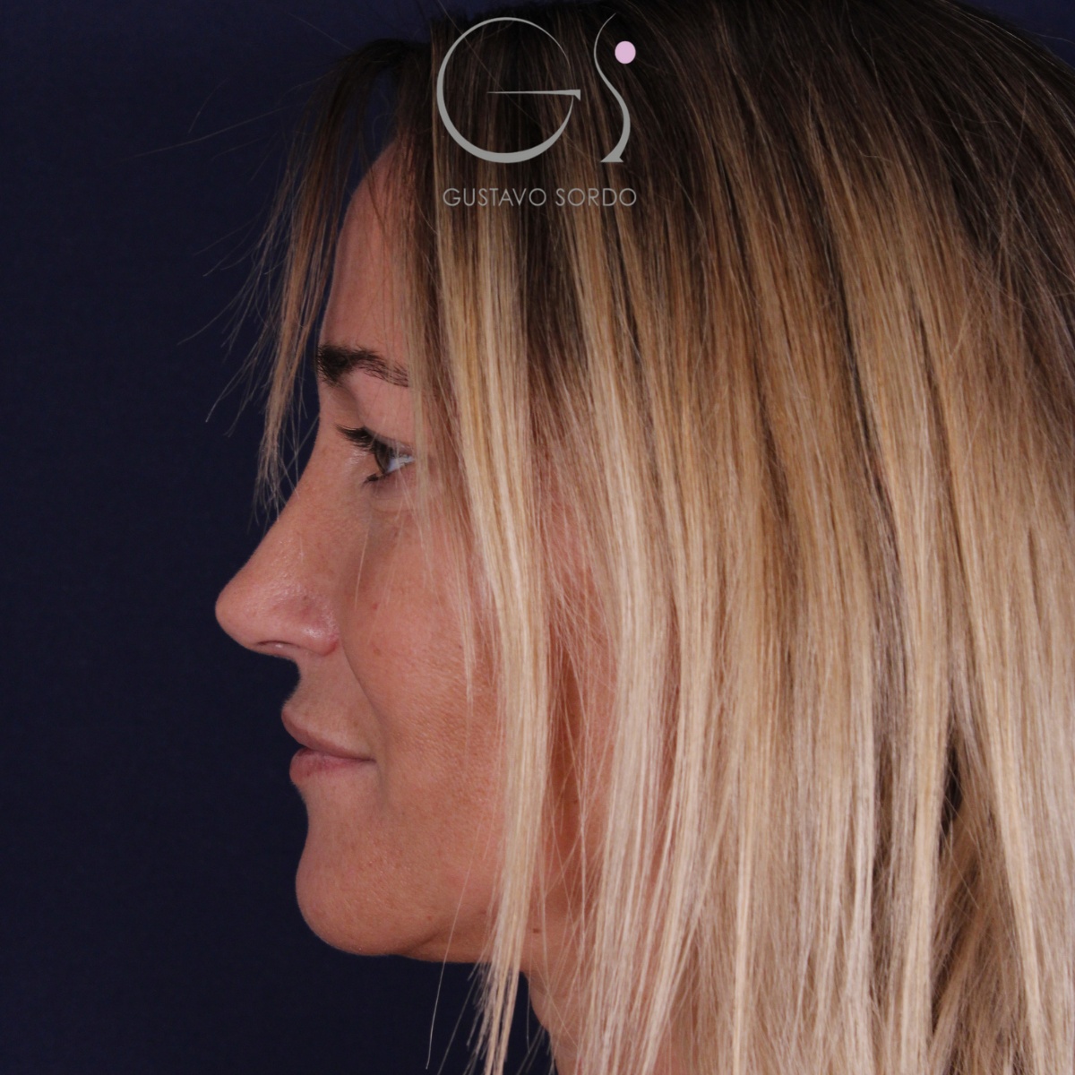 Rinoplastia: antes y después de un caso operado por el Dr. Gustavo Sordo en Madrid