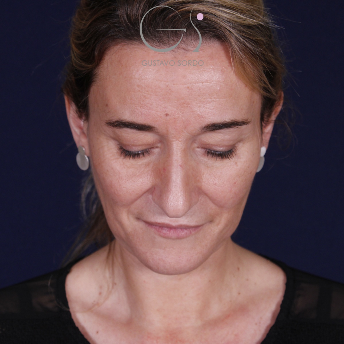 Rinoplastia: antes y después de un caso operado por el Dr. Gustavo Sordo en Madrid