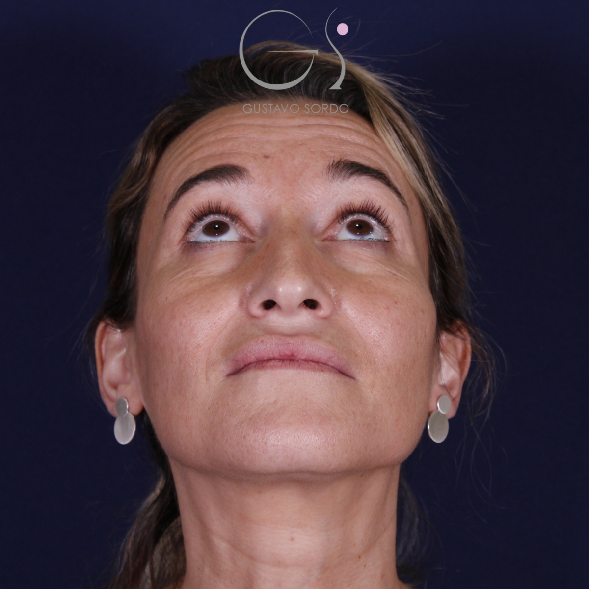 Rinoplastia: antes y después de un caso operado por el Dr. Gustavo Sordo en Madrid