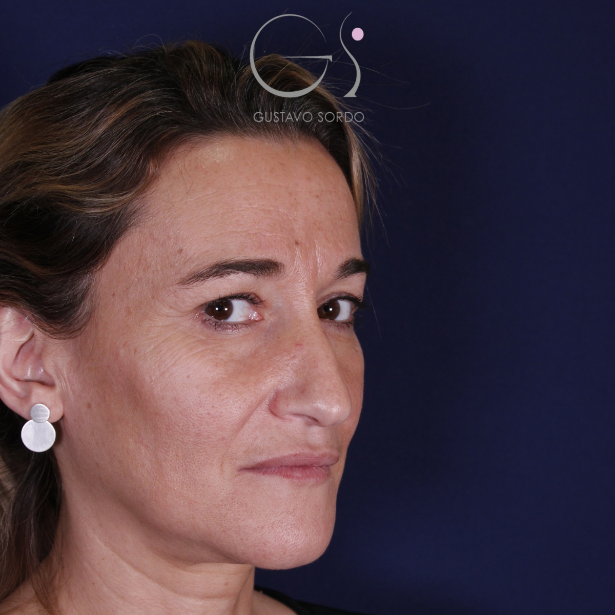 Rinoplastia: antes y después de un caso operado por el Dr. Gustavo Sordo en Madrid