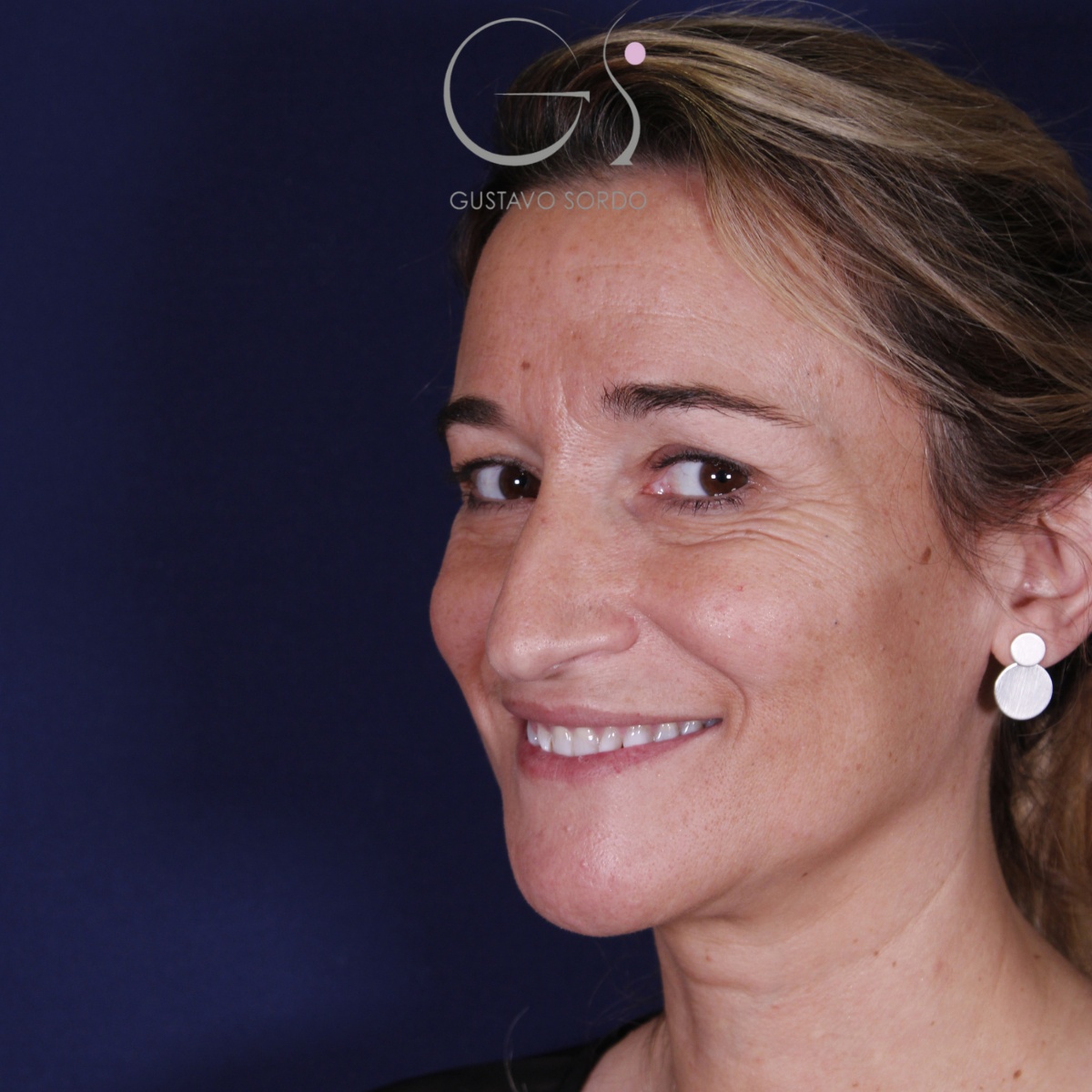 Rinoplastia: antes y después de un caso operado por el Dr. Gustavo Sordo en Madrid