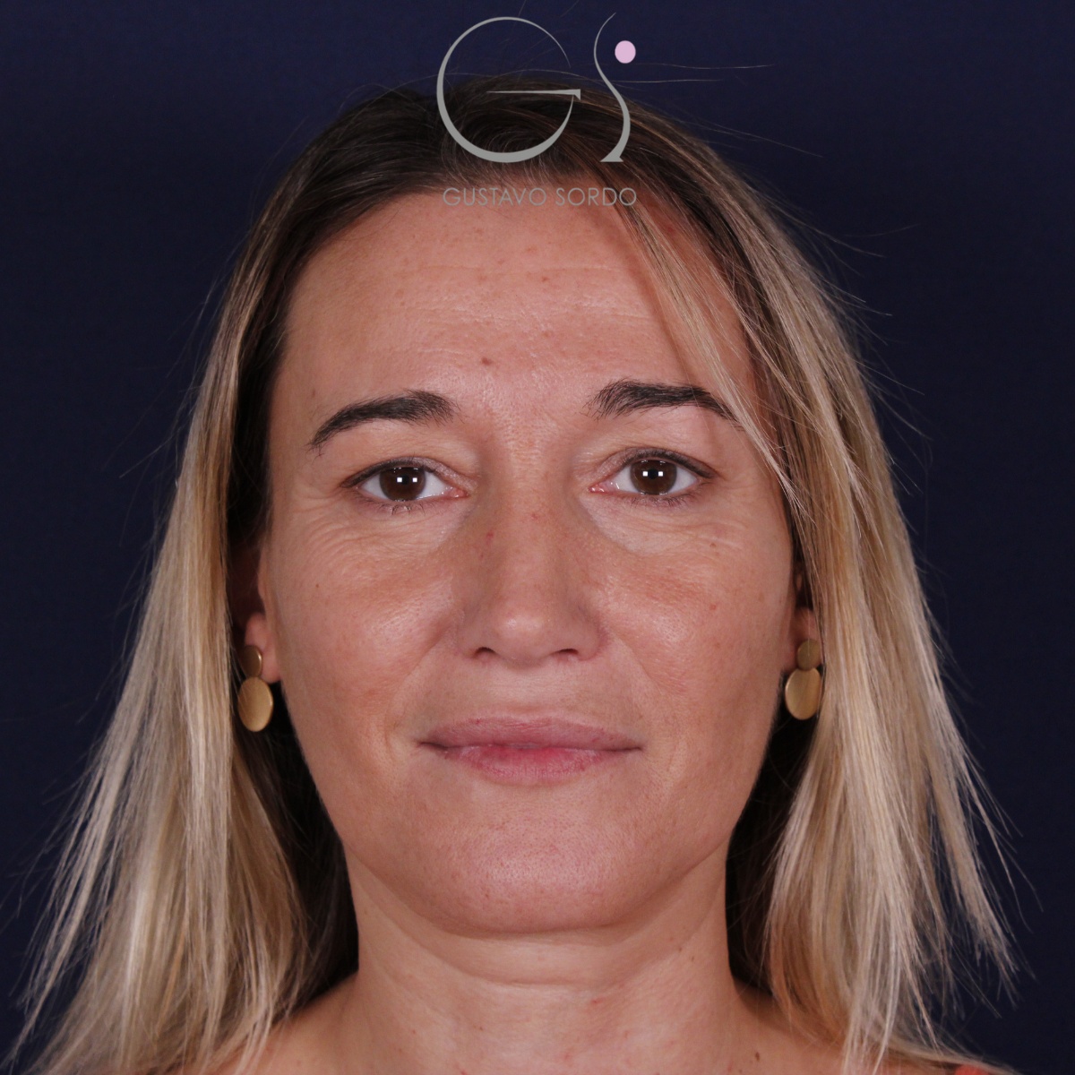 Rinoplastia: antes y después de un caso operado por el Dr. Gustavo Sordo en Madrid