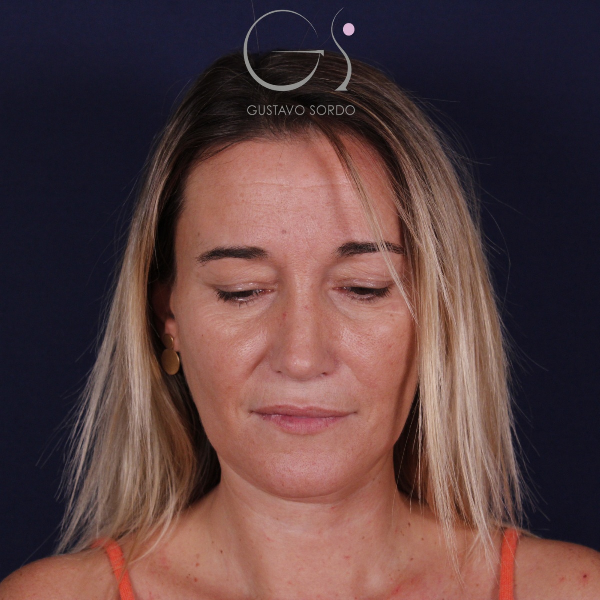Rinoplastia: antes y después de un caso operado por el Dr. Gustavo Sordo en Madrid