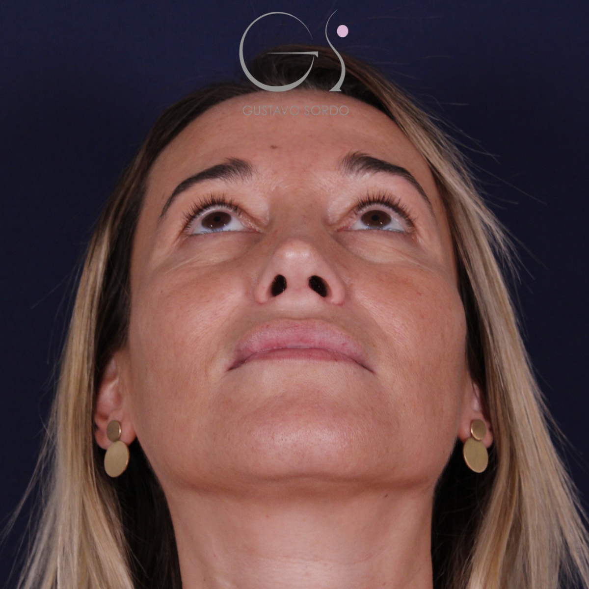 Rinoplastia: antes y después de un caso operado por el Dr. Gustavo Sordo en Madrid