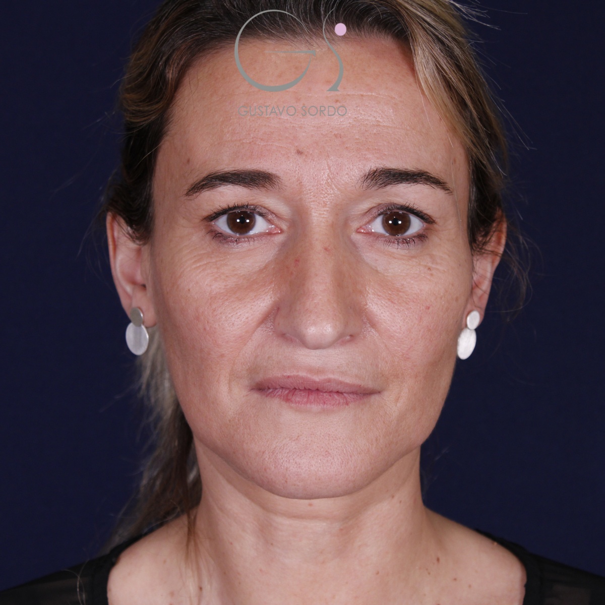Rinoplastia: antes y después de un caso operado por el Dr. Gustavo Sordo en Madrid