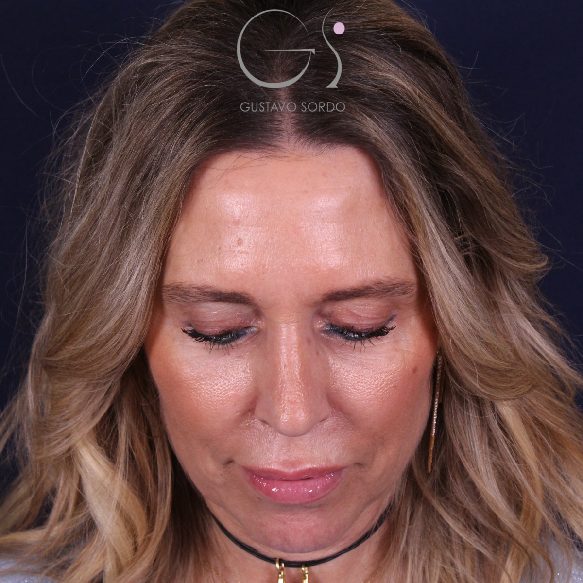 Rinoplastia — piel gruesa: antes y después de un caso operado por el Dr. Gustavo Sordo en Madrid