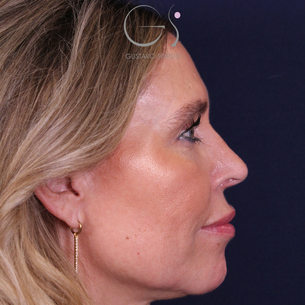 Rinoplastia — piel gruesa: antes y después de un caso operado por el Dr. Gustavo Sordo en Madrid