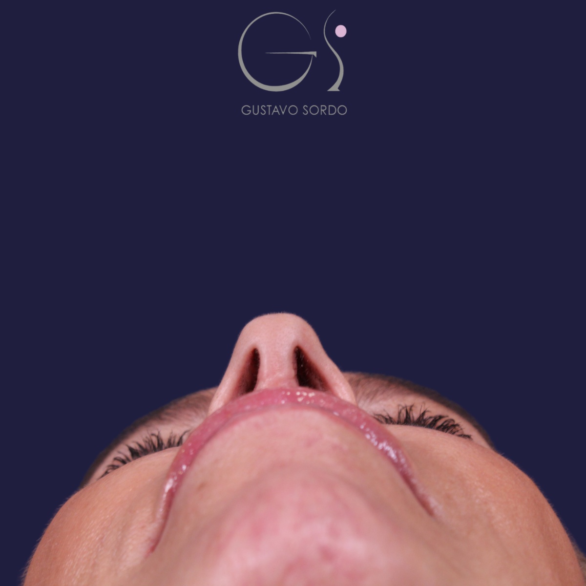 Rinoplastia — piel gruesa: antes y después de un caso operado por el Dr. Gustavo Sordo en Madrid