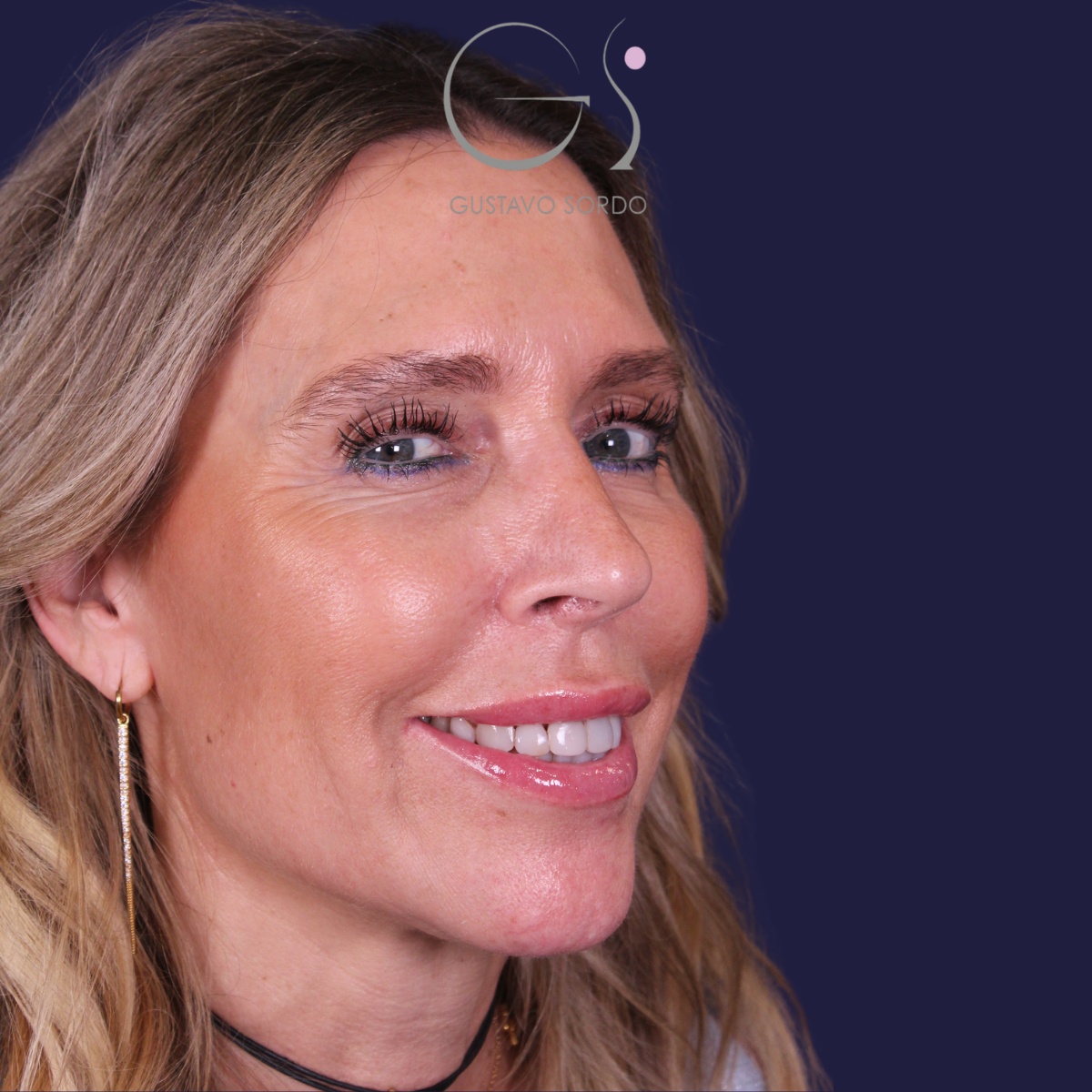 Rinoplastia — piel gruesa: antes y después de un caso operado por el Dr. Gustavo Sordo en Madrid