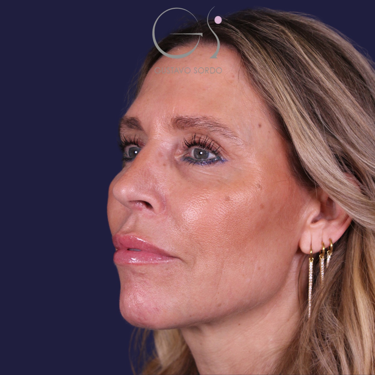 Rinoplastia — piel gruesa: antes y después de un caso operado por el Dr. Gustavo Sordo en Madrid
