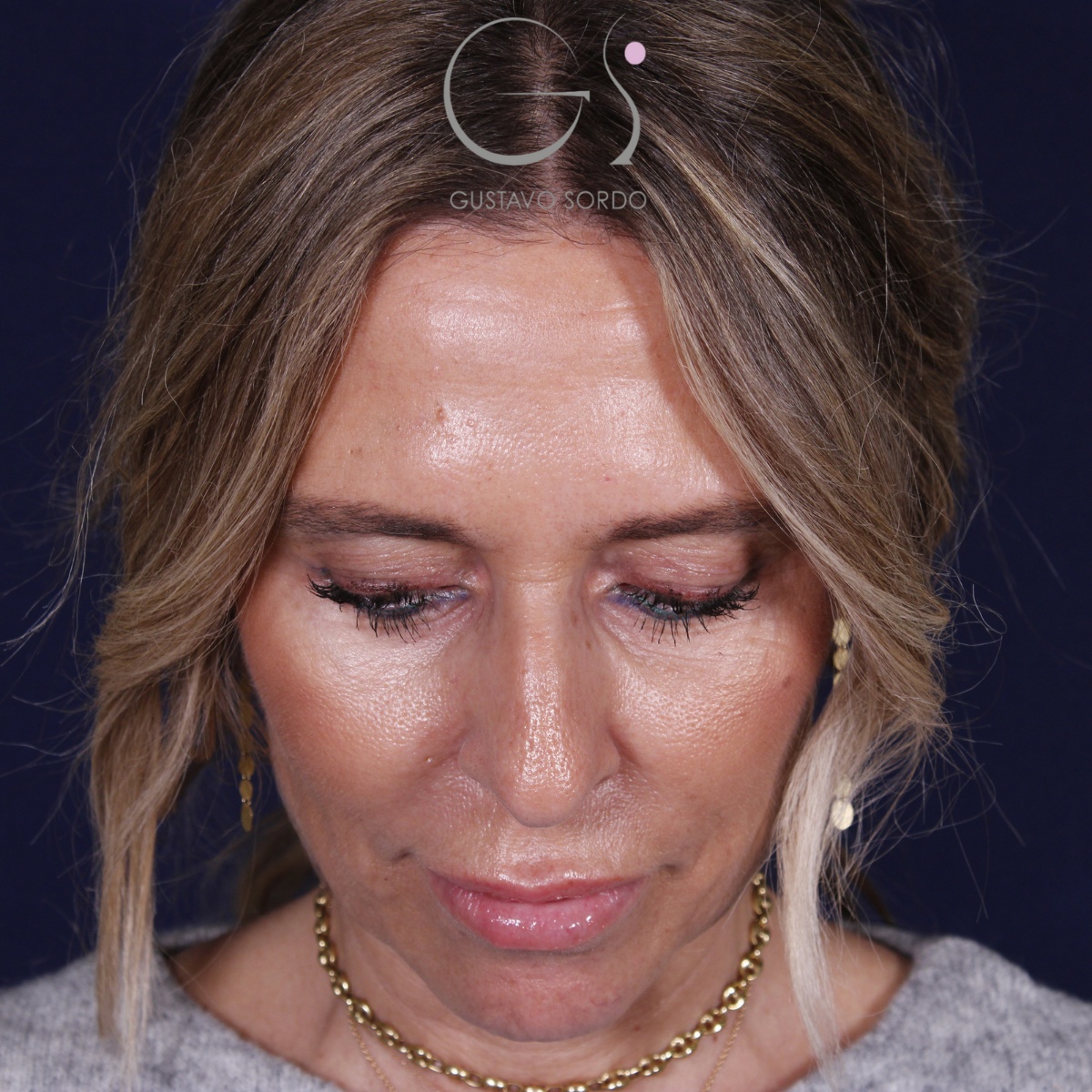 Rinoplastia — piel gruesa: antes y después de un caso operado por el Dr. Gustavo Sordo en Madrid