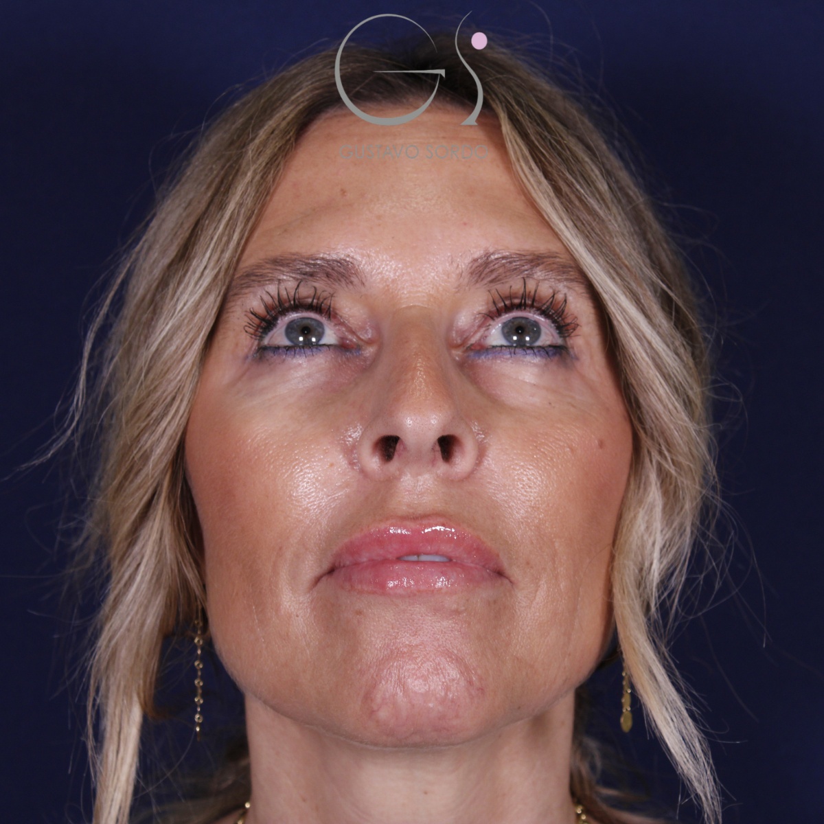 Rinoplastia — piel gruesa: antes y después de un caso operado por el Dr. Gustavo Sordo en Madrid