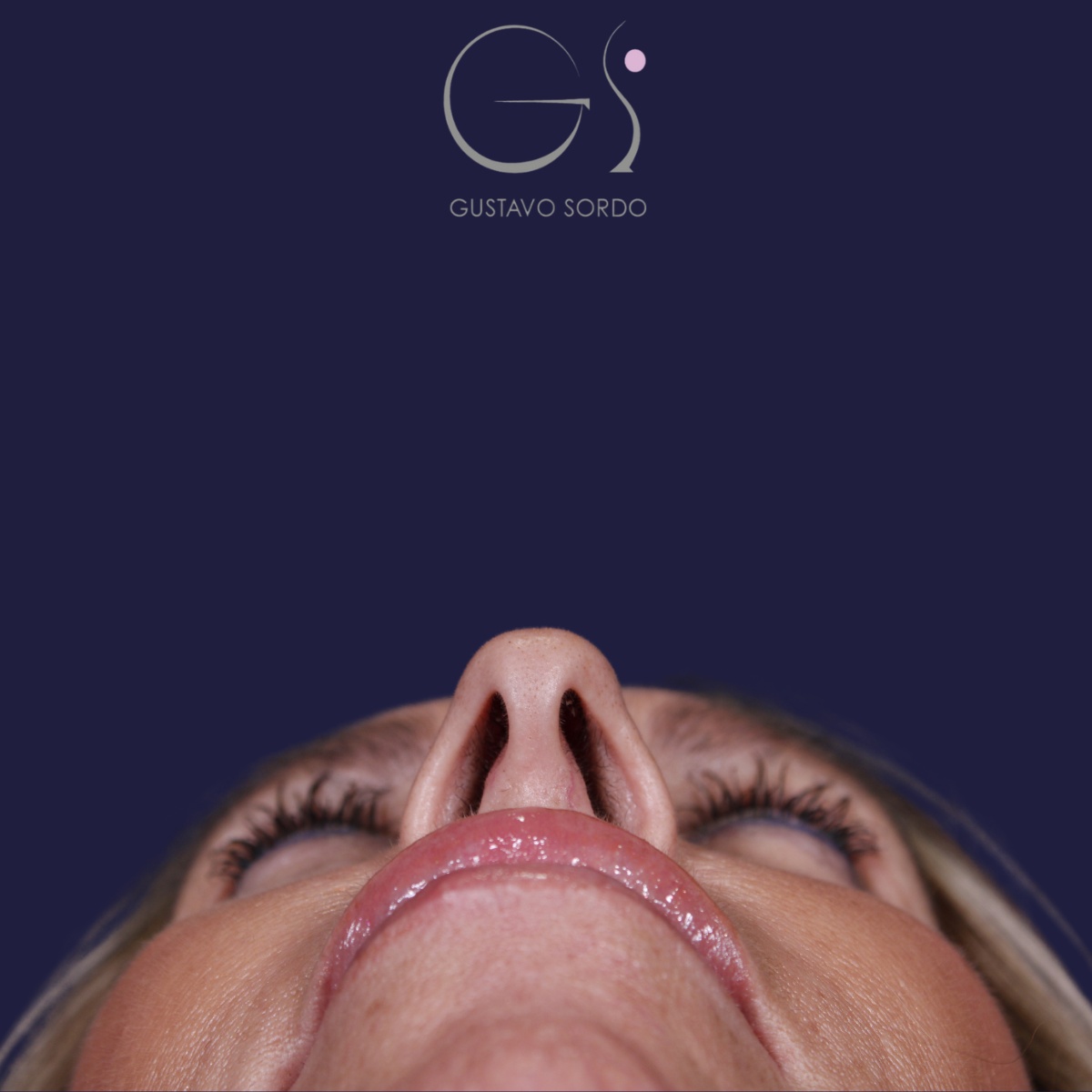 Rinoplastia — piel gruesa: antes y después de un caso operado por el Dr. Gustavo Sordo en Madrid